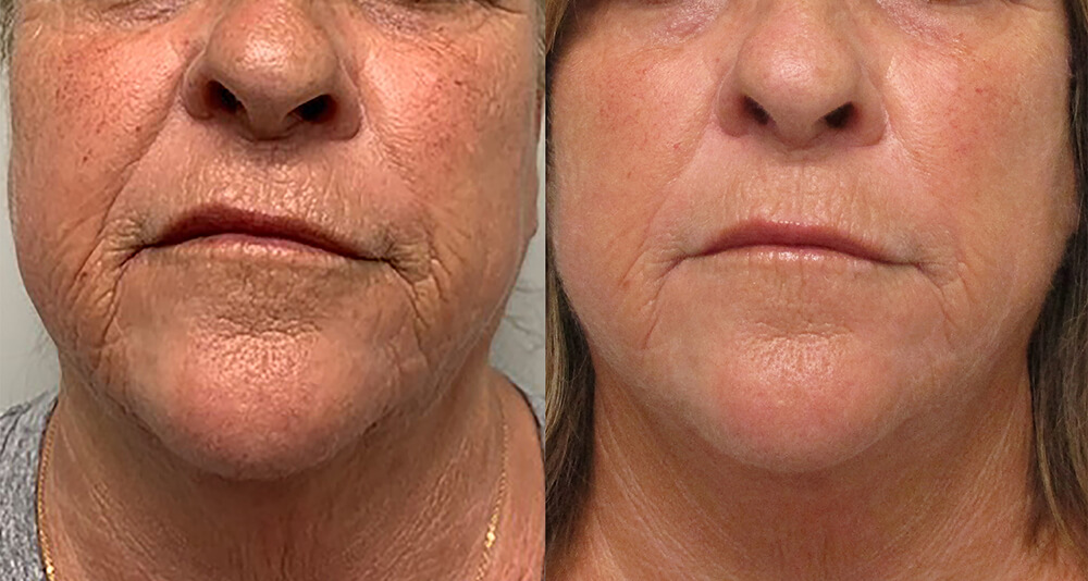 before and after faces of morpheus 8 treatments