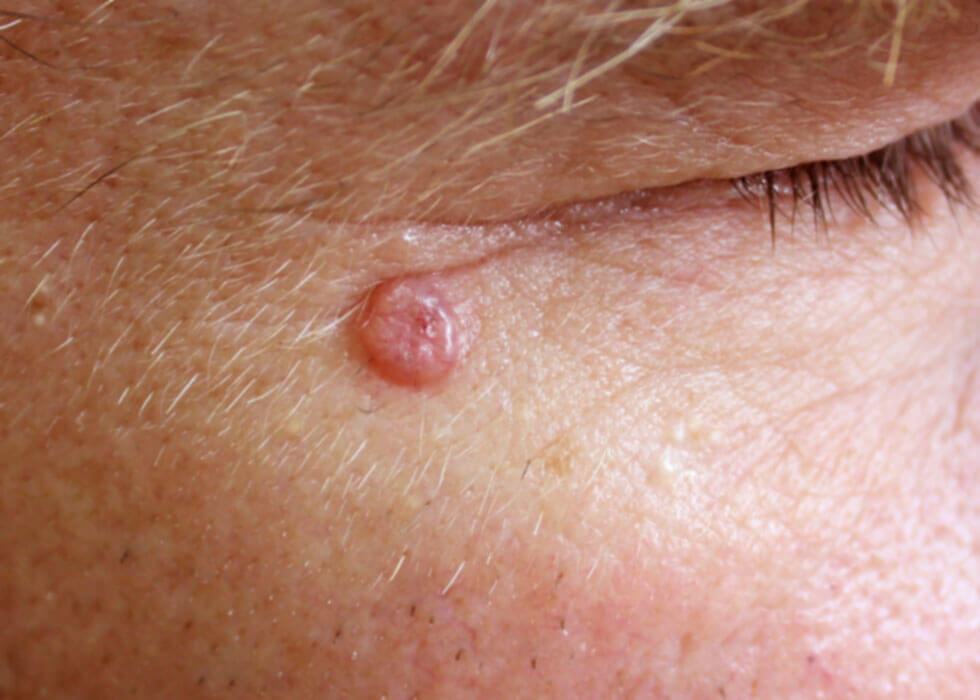 Hpv Warts On Face Treatment Basal Cell Carcinoma Laurusmedical My Xxx