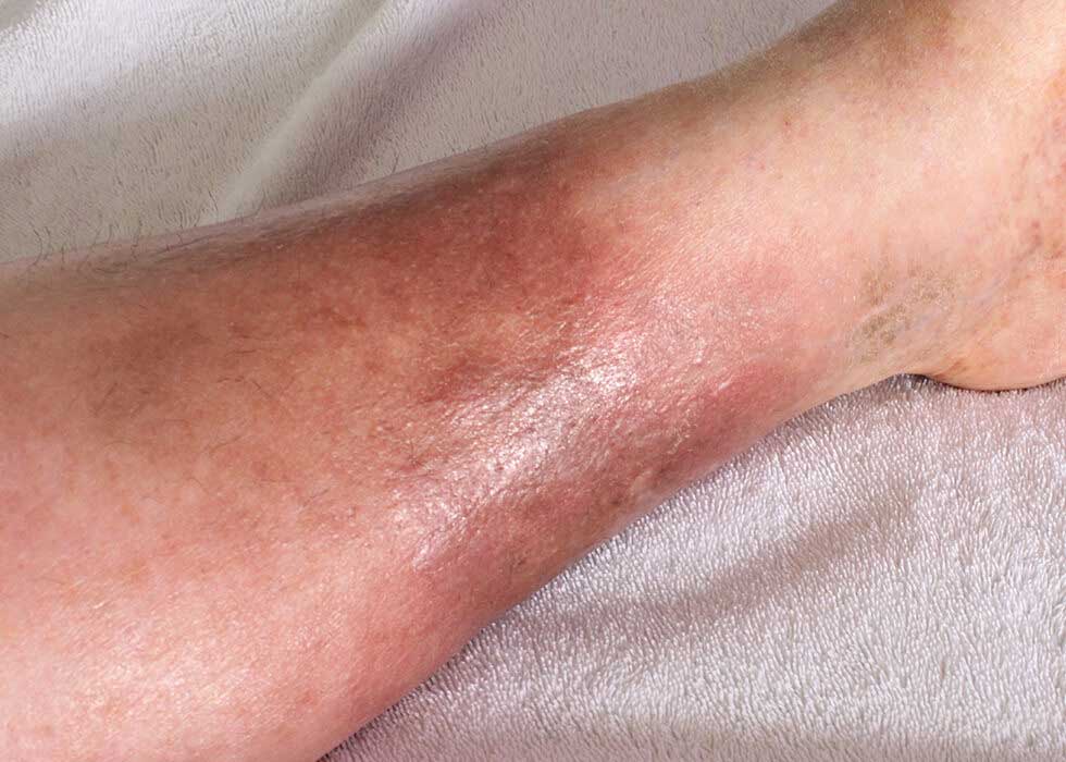 cellulitis infection