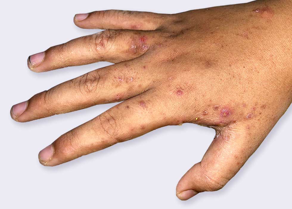 What Is Scabies? Learn About Its Causes, Symptoms And Treatment